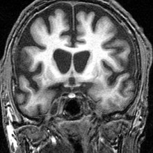人脑尾状核水平的冠状图像显示显着的体积缩小，与患者已知的亨廷顿病诊断一致。