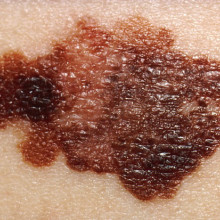 照片显示黑色素瘤的外观，黑色素瘤是一种色素皮肤癌。