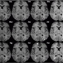 多发性硬化症:每隔一个月扫描一次同一脑片的t1加权MRI(对比后)。脑组织内的亮点表明有活动性病变。