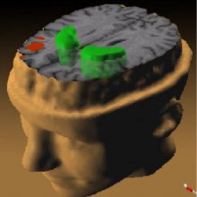 PET扫描，说明精神分裂症对大脑的影响