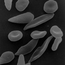 镰状细胞性贫血患者的镰状红细胞
